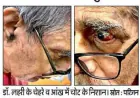 BHU के ICU में पद्मश्री डॉ. टीके लहरी से कथित बदसलूकी और थप्पड़ का आरोप, मेडिकल बोर्ड ने शुरू की जाँच